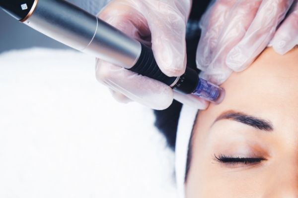 How much does microneedling cost