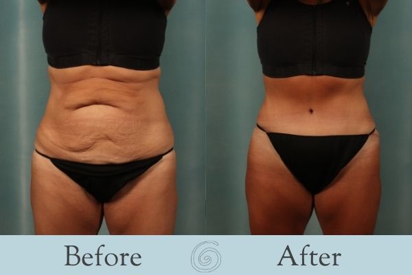 Tummy Tuck Before and After 1 - Front
