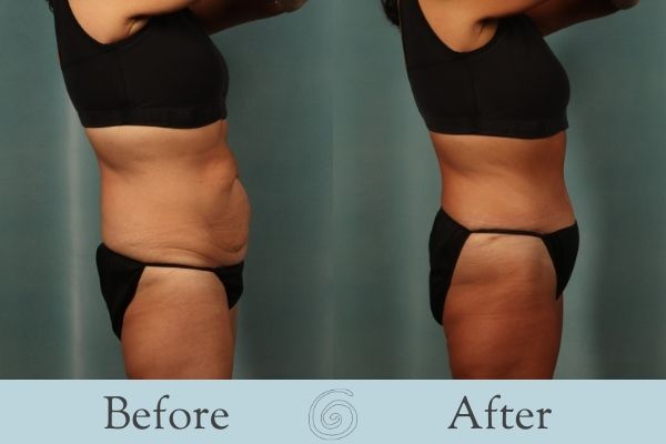 Tummy Tuck Before and After 1 - Side
