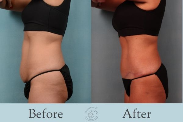 Tummy Tuck Before and After 11 - Side