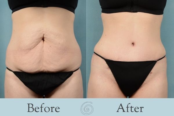 Tummy Tuck Before and After 12 - Front