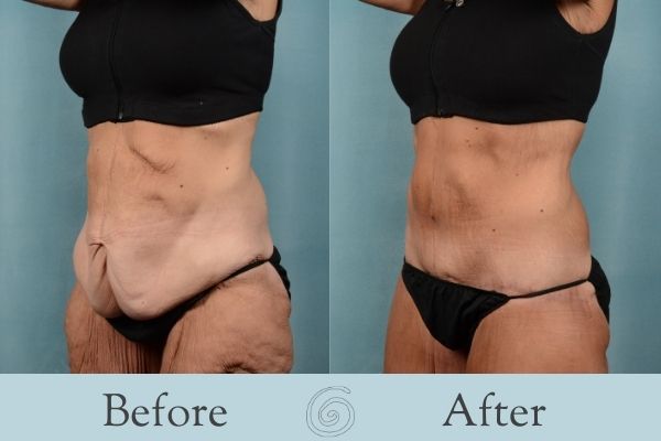 Tummy Tuck Before and After 13 - Side