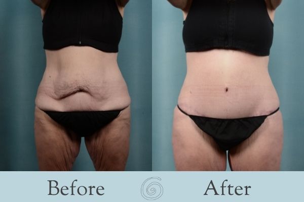Tummy Tuck Before and After 14 - Front
