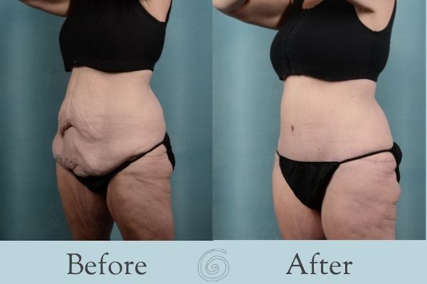Tummy Tuck Before and After 14 - Side