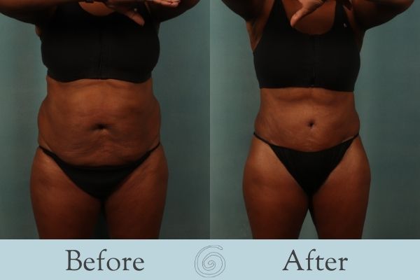 Tummy Tuck Before and After 3 - Front
