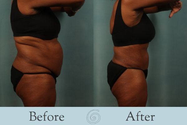 Tummy Tuck Before and After 3 - Side