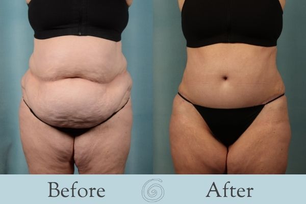 Tummy Tuck Before and After 4 - Front