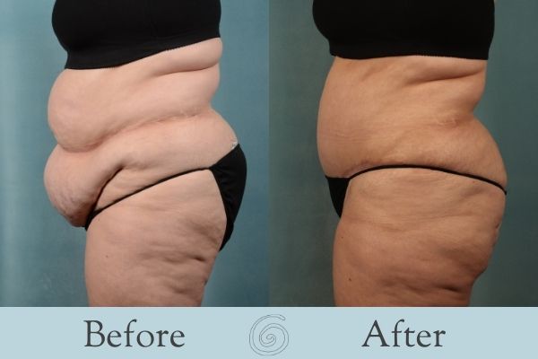 Tummy Tuck Before and After 4 - Side