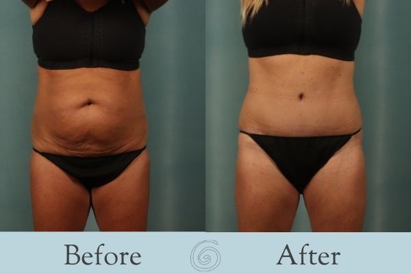 Tummy Tuck Before and After 6 - Front