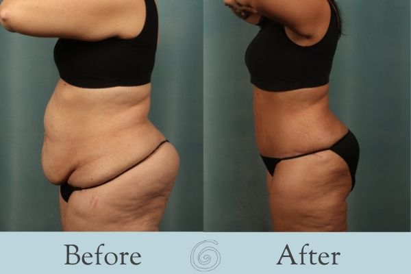Tummy Tuck Before and After 7 - Side