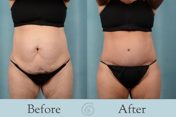 Tummy Tuck Before and After 8 - Front