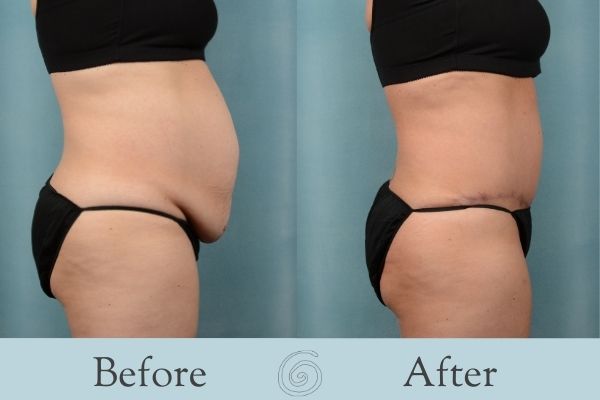 Tummy Tuck Before and After 8 - Side