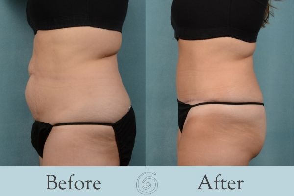 Tummy Tuck Before and After 9 - Side