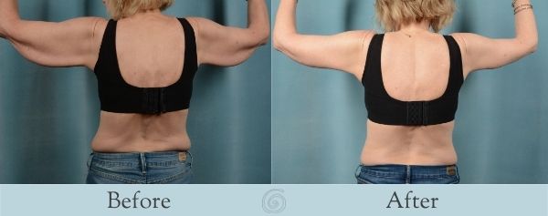 Arm Lift Before and After 1