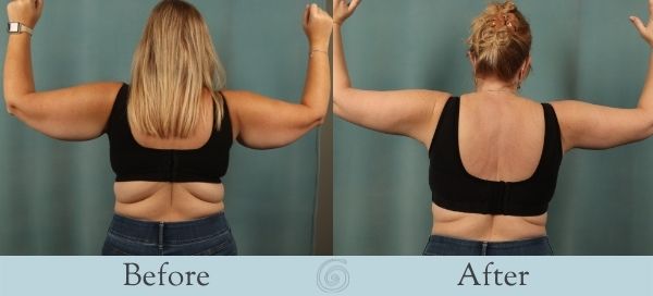 Arm Lift Before and After 2