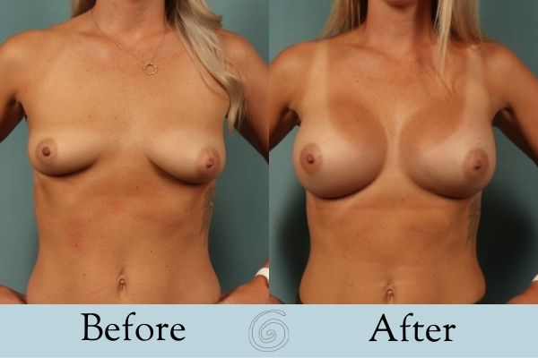Breast Augmentation Before and After 1 _ Front
