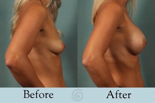 Breast Augmentation Before and After 1 _ Side