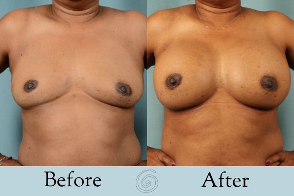 Breast Augmentation Before and After 10 _ Front