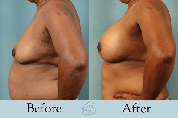 Breast Augmentation Before and After 10 _ Side
