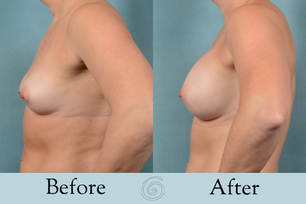 Breast Augmentation Before and After 12 _ Front