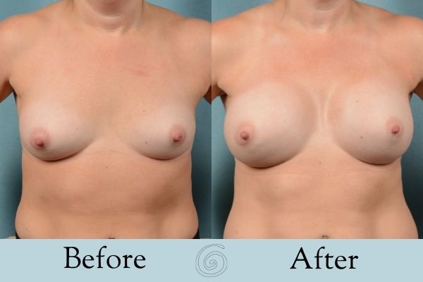 Breast Augmentation Before and After 12 _ Side