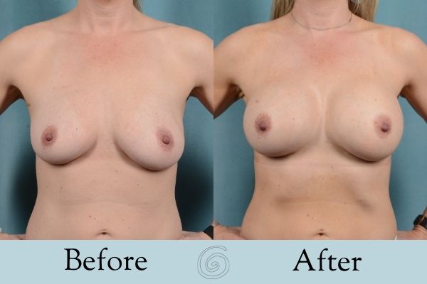 Breast Augmentation Before and After 13 _ Front