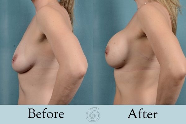 Breast Augmentation Before and After 13 _ Side
