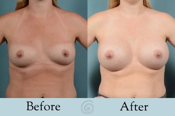 Breast Augmentation Before and After 15 _ Front