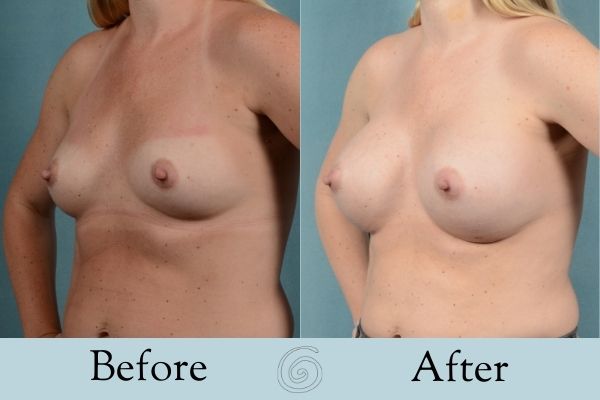 Breast Augmentation Before and After 15 _ Side