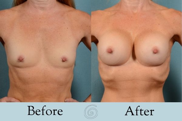 Breast Augmentation Before and After 17 _ Front