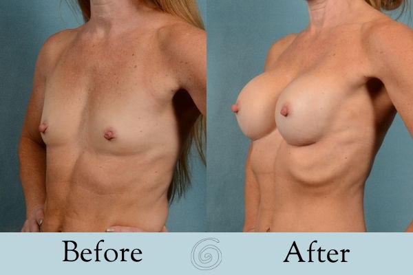 Breast Augmentation Before and After 17 _ Side