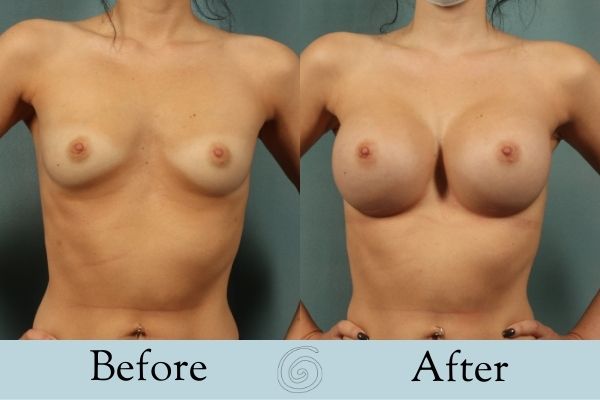 Breast Augmentation Before and After 2 _ Front