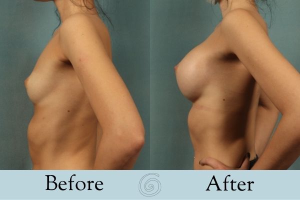 Breast Augmentation Before and After 2 _ Side