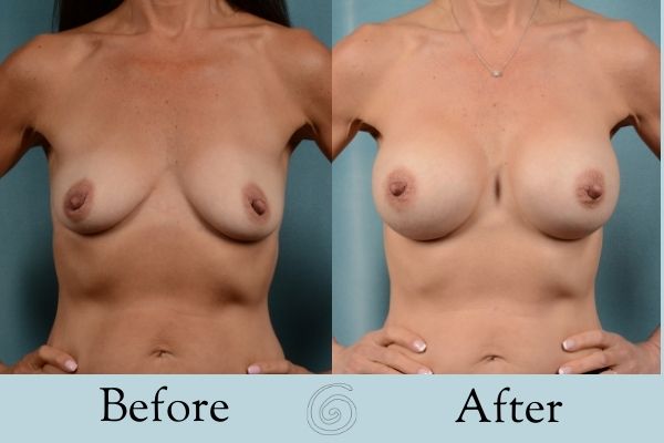 Breast Augmentation Before and After 23 _ Front