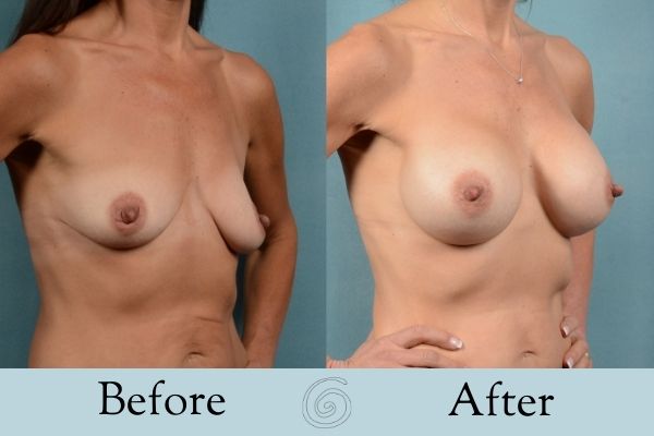 Breast Augmentation Before and After 23 _ Side