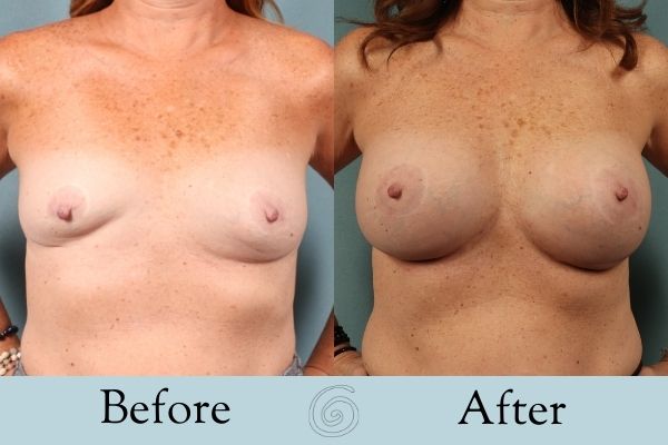 Breast Augmentation Before and After 24 _ Front
