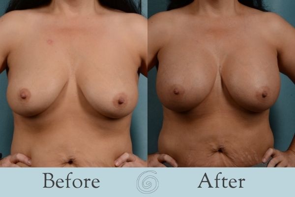 Breast Augmentation Before and After 26 - Front