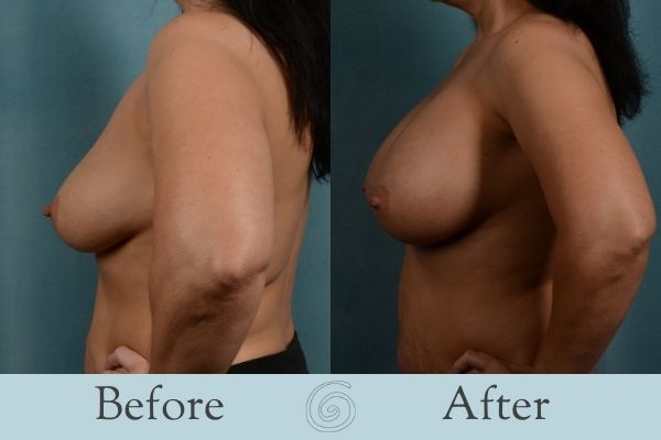 Breast Augmentation Before and After 26 - Side