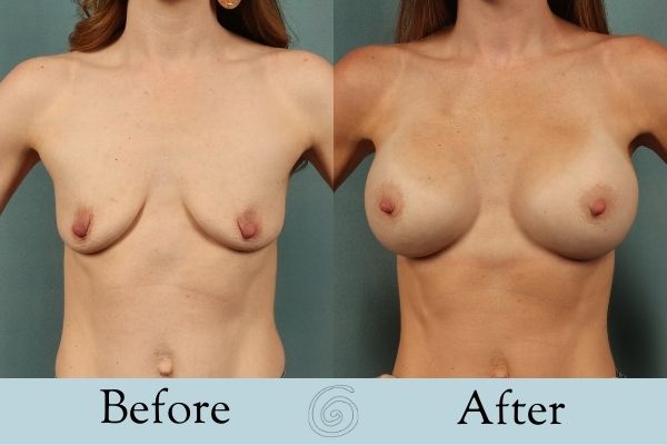 Breast Augmentation Before and After 3 _ Front
