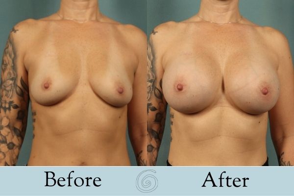 Breast Augmentation Before and After 4 _ Front