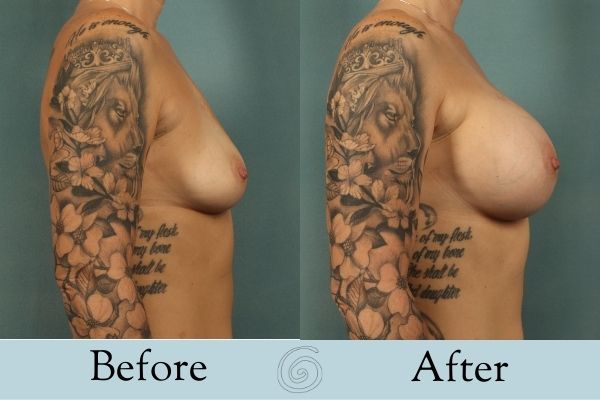 Breast Augmentation Before and After 4 _ Side