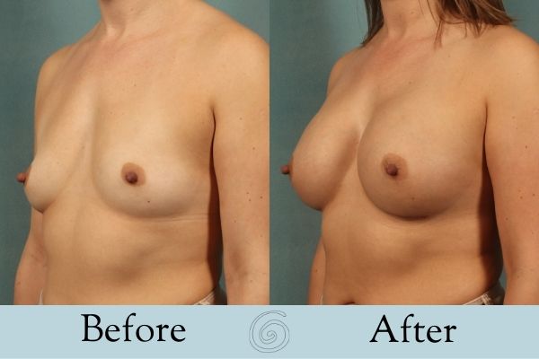 Breast Augmentation Before and After 5 _ Side