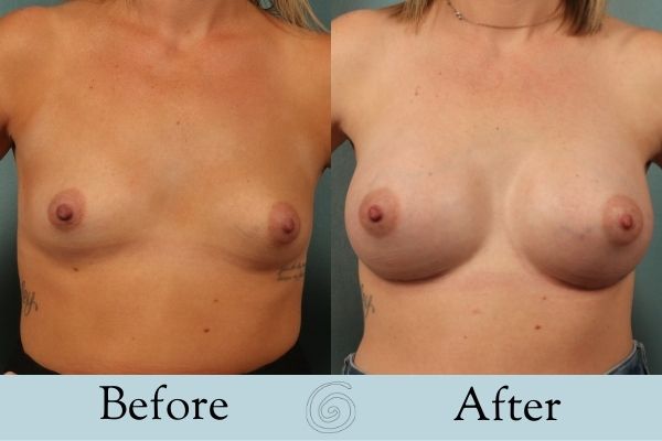 Breast Augmentation Before and After 6 _ Front