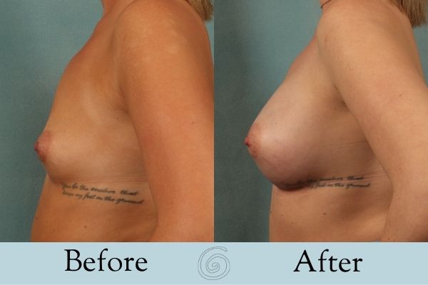 Breast Augmentation Before and After 6 _ Side