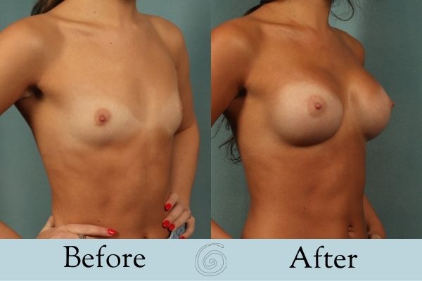 Breast Augmentation Before and After 7 _ Front