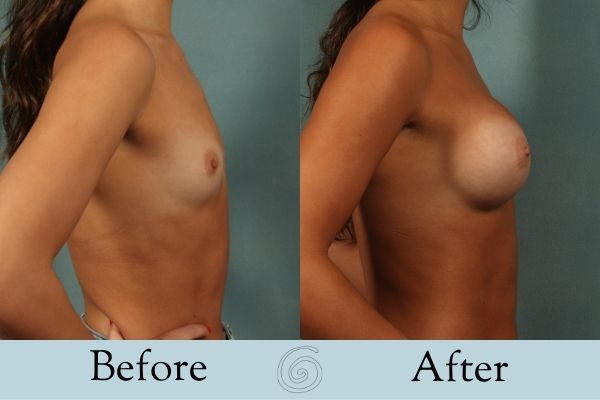 Breast Augmentation Before and After 7 _ Side