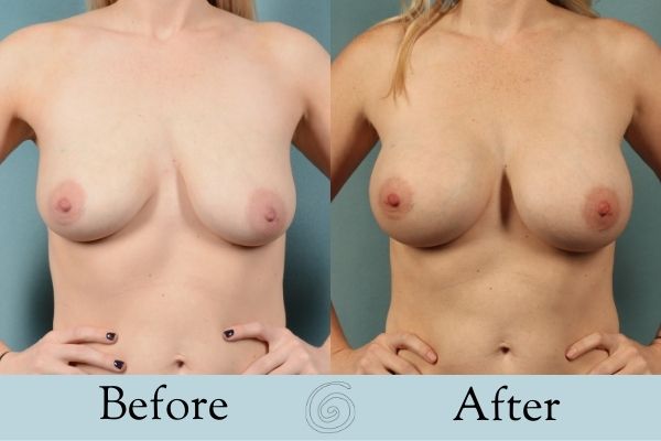 Breast Augmentation Before and After 8 _ Front
