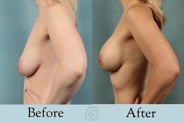Breast Augmentation Before and After 8 _ Side