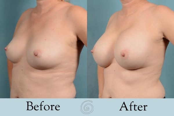 Breast Augmentation Before and After 9 _ Side