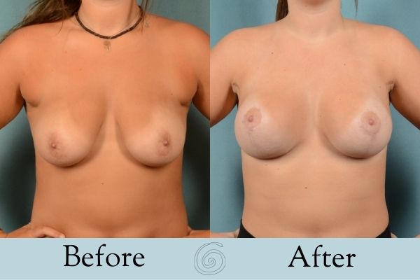 Breast Augmentation and Lift Before and After 4 _ Front